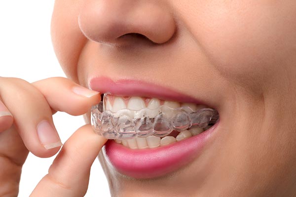 Miami Florida Invisalign - woman placing clear aligners on her teeth.