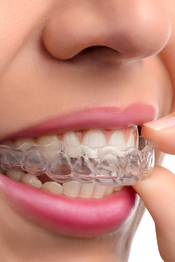 Close-up of a woman placing Invisalign on her teeth.