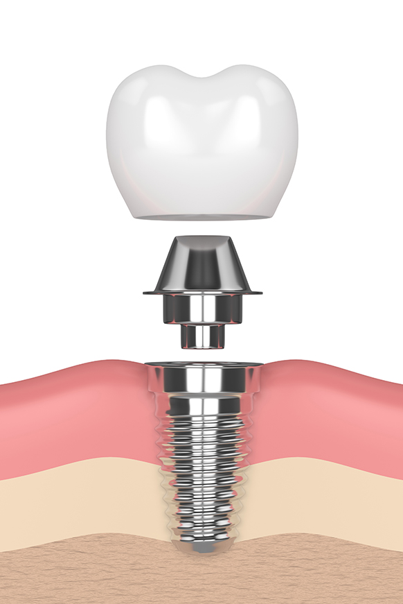 Dental implant diagram