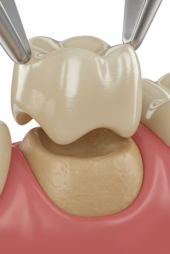Dental crown diagram
