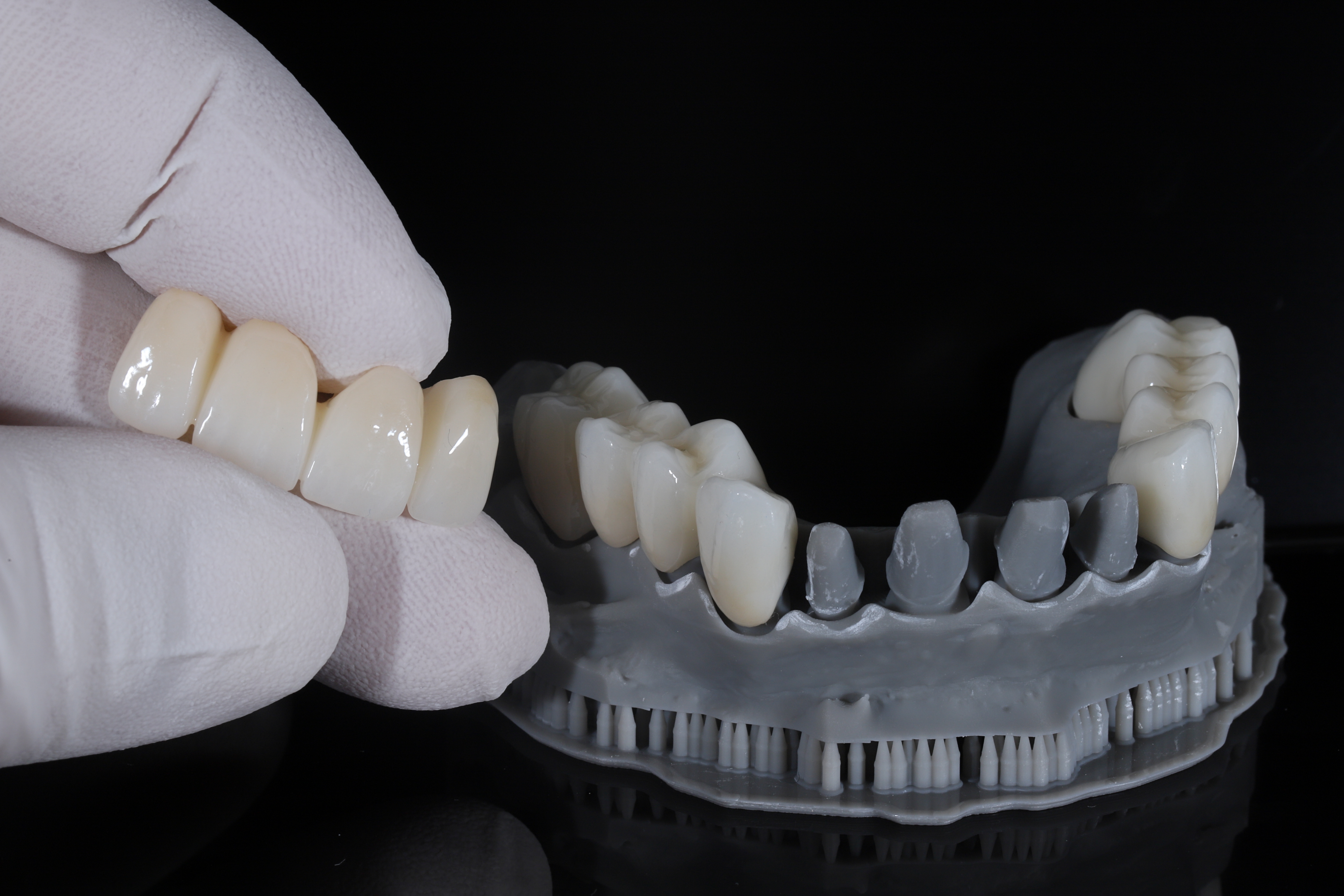 Dental bridges in Miami