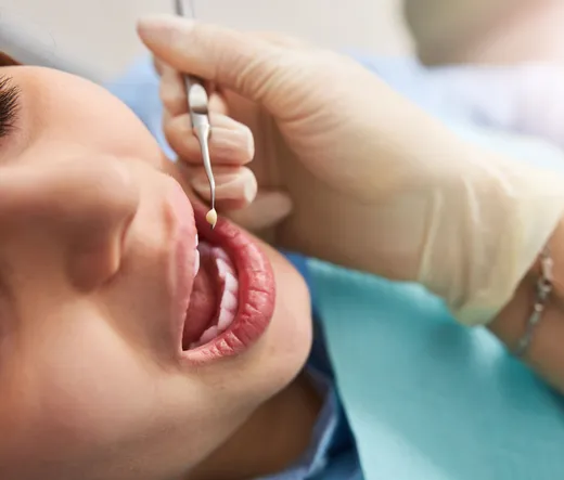 Tooth with white composite filling in Miami