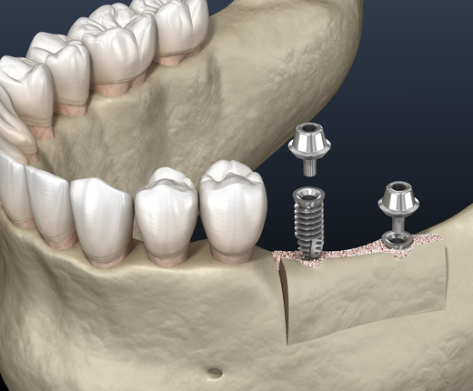 Ridge augmentation in Miami