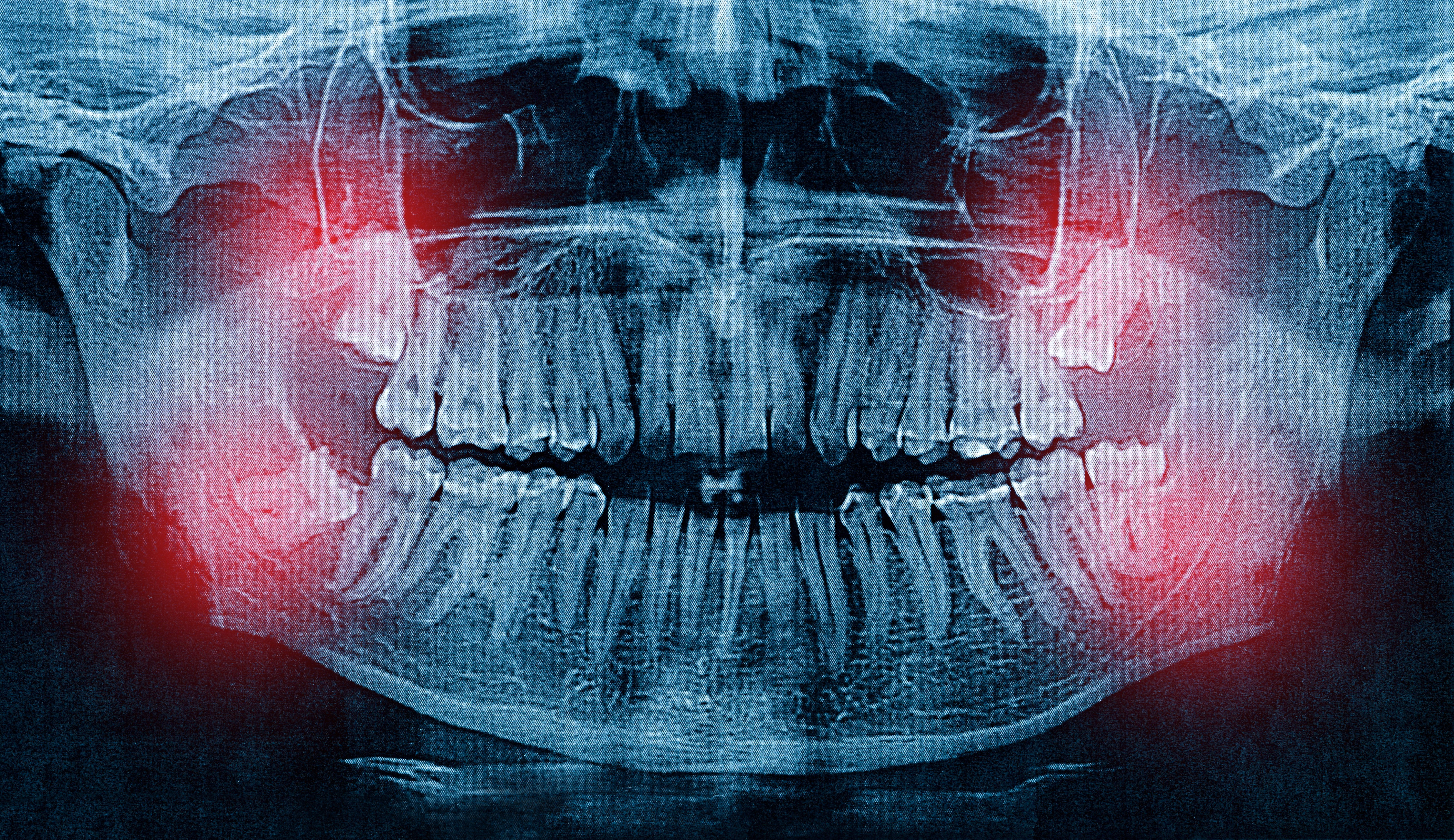Wisdom teeth removal in Miami
