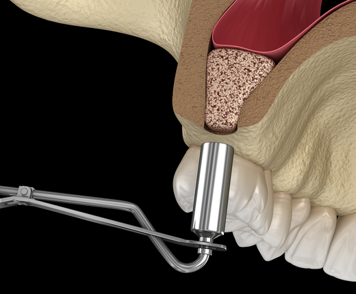 Sinus lift procedure in Miami