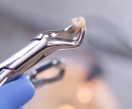 Tooth extractions treatment